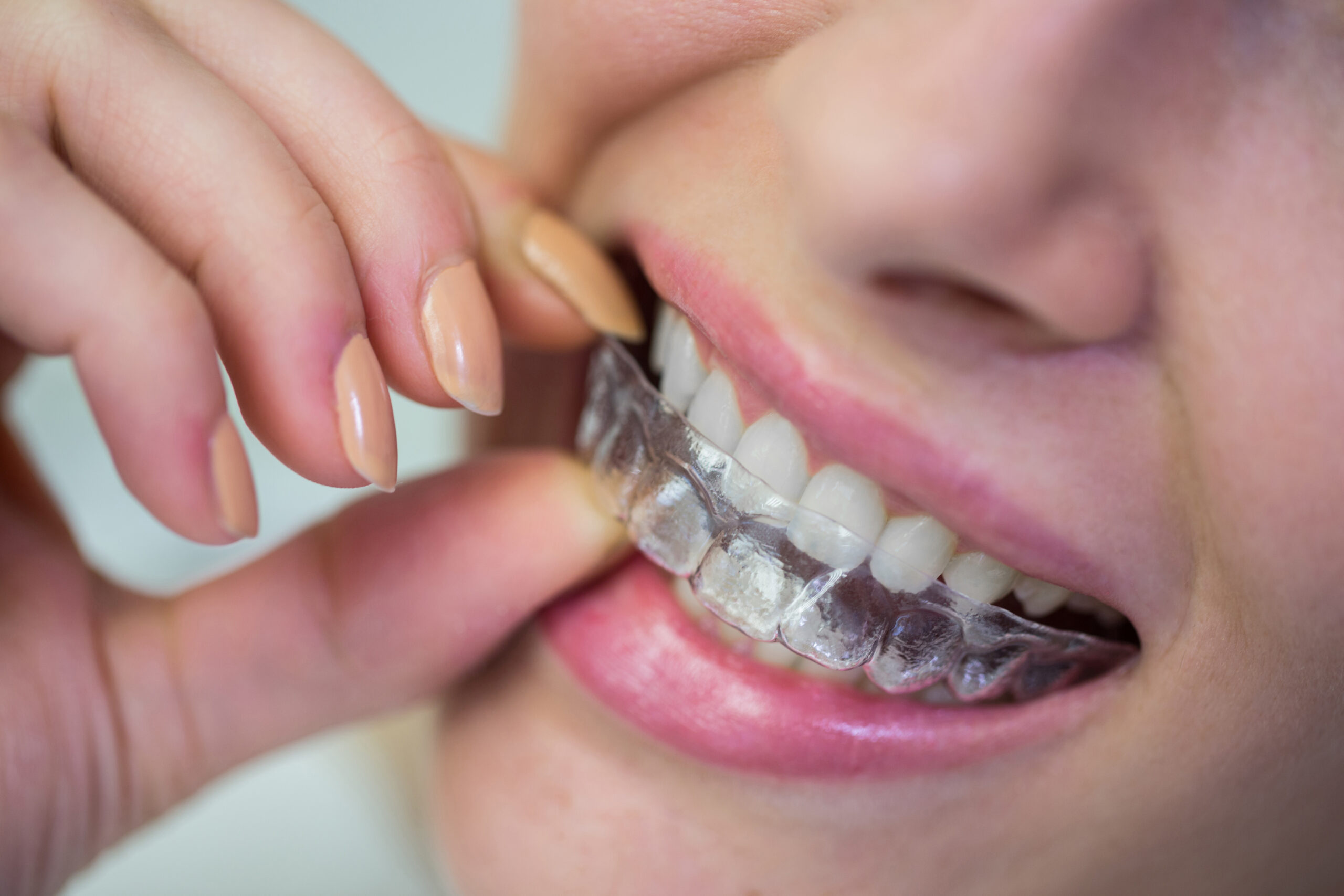 Invisalign Westlake Village CA